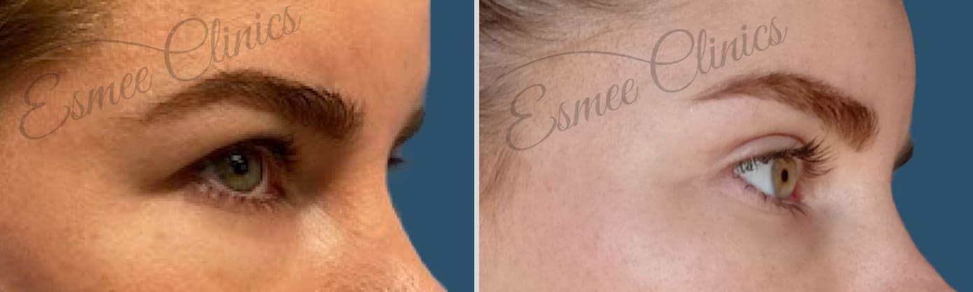 Before and After img